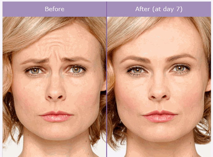 Botox Before and After Pictures Washington, DC