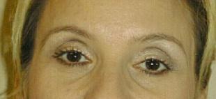 Brow Lift Before and After Pictures Washington, DC