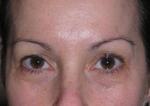 Brow Lift Before and After Pictures Washington, DC