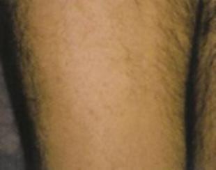 Laser Hair Removal Before and After Pictures Washington, DC