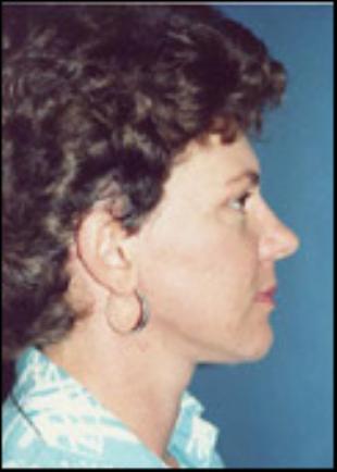 Neck Lift Before and After Pictures Washington, DC