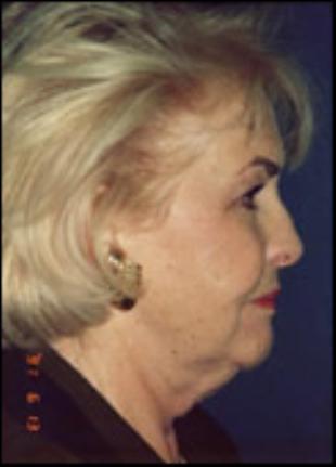 Neck Lift Before and After Pictures Washington, DC