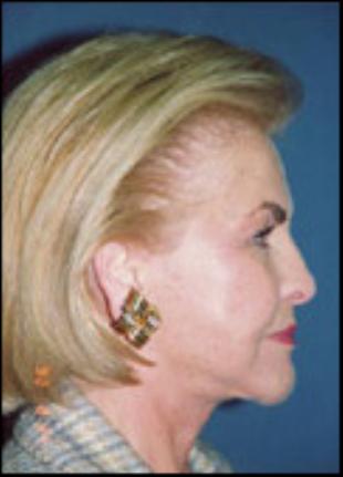 Neck Lift Before and After Pictures Washington, DC