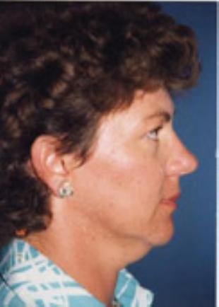 Neck Lift Before and After Pictures Washington, DC