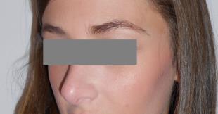 Rhinoplasty Before and After Pictures Washington, DC