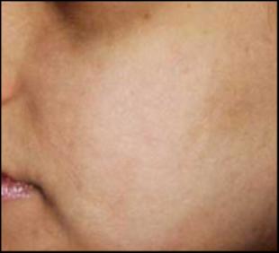 Scar Revision Before and After Pictures Washington, DC