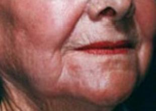 Skin Resurfacing Before and After Pictures Washington, DC