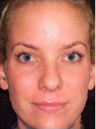 Skin Resurfacing Before and After Pictures Washington, DC