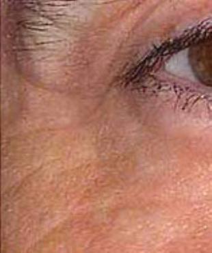 Wrinkle Removal Before and After Pictures Washington, DC
