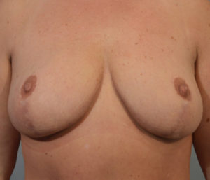 Breast Lift Before and After Pictures Washington, DC