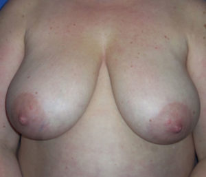 Breast Lift Before and After Pictures Washington, DC