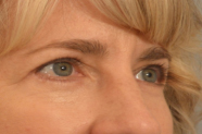 Eyelid Surgery Before and After Pictures Washington, DC