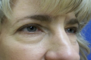 Eyelid Surgery Before and After Pictures Washington, DC