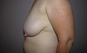 Breast Reduction Before and After Pictures Washington, DC