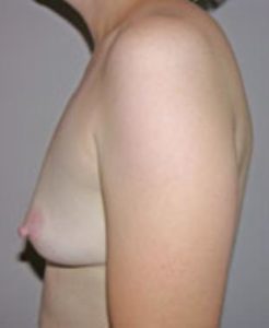 Breast Augmentation Before and After Pictures Washington, DC