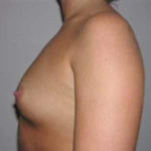 Breast Augmentation Before and After Pictures Washington, DC