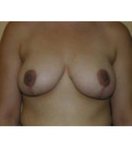 Breast Lift Before and After Pictures Washington, DC