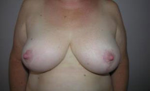 Breast Reduction Before and After Pictures Washington, DC