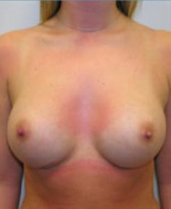 Breast Augmentation Before and After Pictures Washington, DC