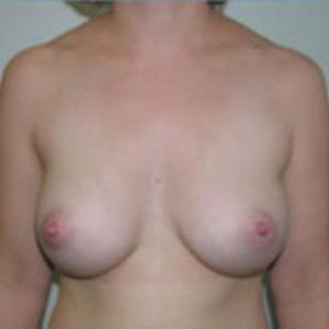 Breast Augmentation Before and After Pictures Washington, DC