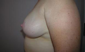 Breast Reduction Before and After Pictures Washington, DC