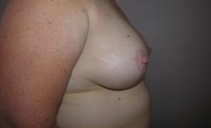 Breast Reduction Before and After Pictures Washington, DC