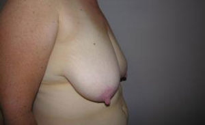 Breast Reduction Before and After Pictures Washington, DC