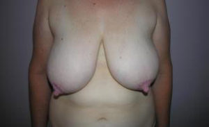 Breast Reduction Before and After Pictures Washington, DC