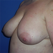 Breast Lift Before and After Pictures Washington, DC