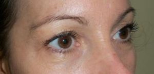 Brow Lift Before and After Pictures Washington, DC