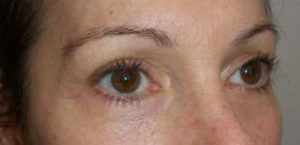 Brow Lift Before and After Pictures Washington, DC