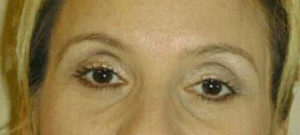 Brow Lift Before and After Pictures Washington, DC