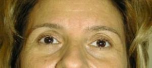 Brow Lift Before and After Pictures Washington, DC