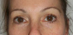 Brow Lift Before and After Pictures Washington, DC