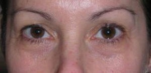 Brow Lift Before and After Pictures Washington, DC