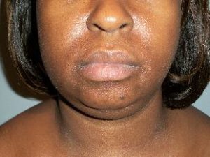 Chin Implants Before and After Pictures Washington, DC