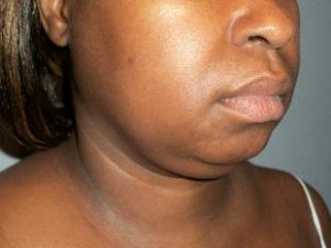 Chin Implants Before and After Pictures Washington, DC