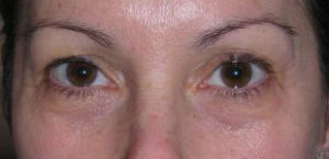 Eyelid Surgery Before and After Pictures Washington, DC