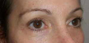 Eyelid Surgery Before and After Pictures Washington, DC