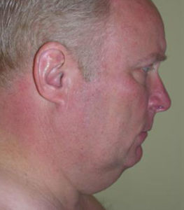 Neck Lift Before and After Pictures Washington, DC