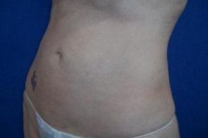 Laser Liposuction Before and After Pictures Washington, DC