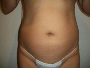 Laser Liposuction Before and After Pictures Washington, DC