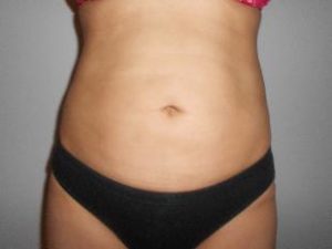 Laser Liposuction Before and After Pictures Washington, DC