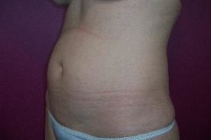 Laser Liposuction Before and After Pictures Washington, DC