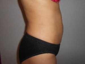 Laser Liposuction Before and After Pictures Washington, DC