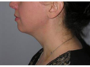 Laser Liposuction Before and After Pictures Washington, DC