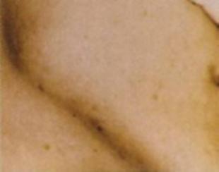 Laser Hair Removal Before and After Pictures Washington, DC