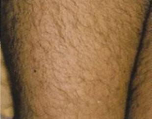 Laser Hair Removal Before and After Pictures Washington, DC