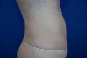 Laser Liposuction Before and After Pictures Washington, DC