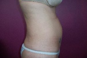 Laser Liposuction Before and After Pictures Washington, DC